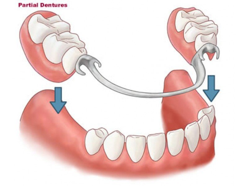 dentures-partial